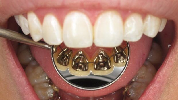 Sabit Ortodontik Tedavi